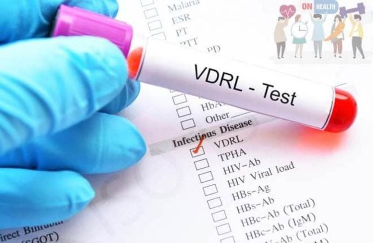 Xét nghiệm nhanh chẩn đoán HIV và giang mai