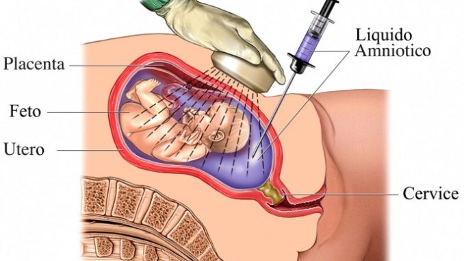 Xét nghiệm nhanh chẩn đoán rỉ ối và hỗ trợ chẩn đoán nguy cơ sinh non